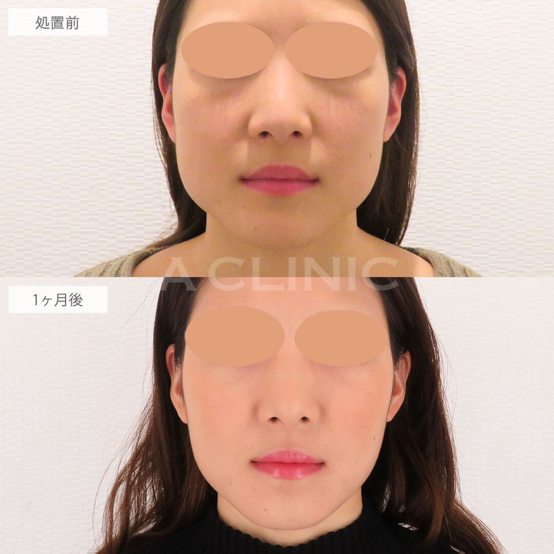 小顔ボトックスの症例写真