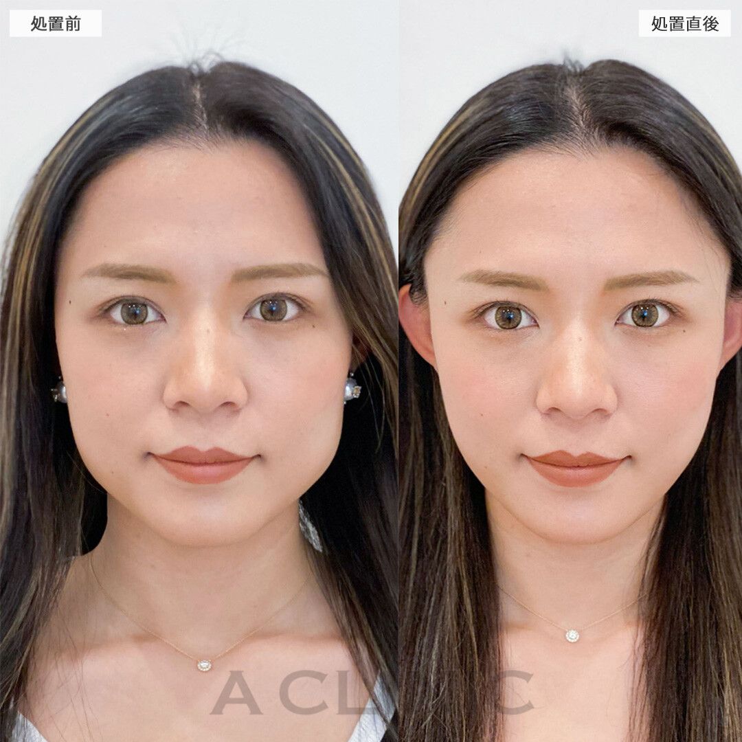 Aスレッド症例写真