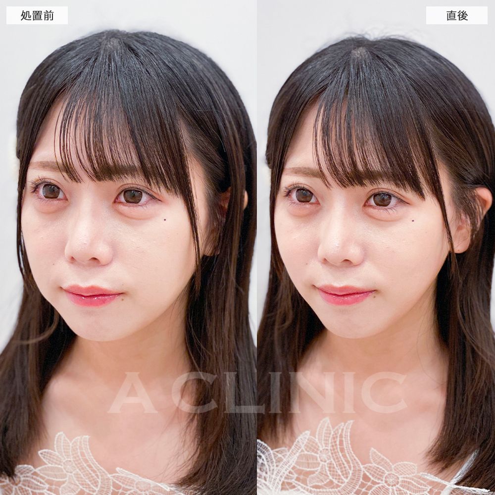Aスレッド症例写真