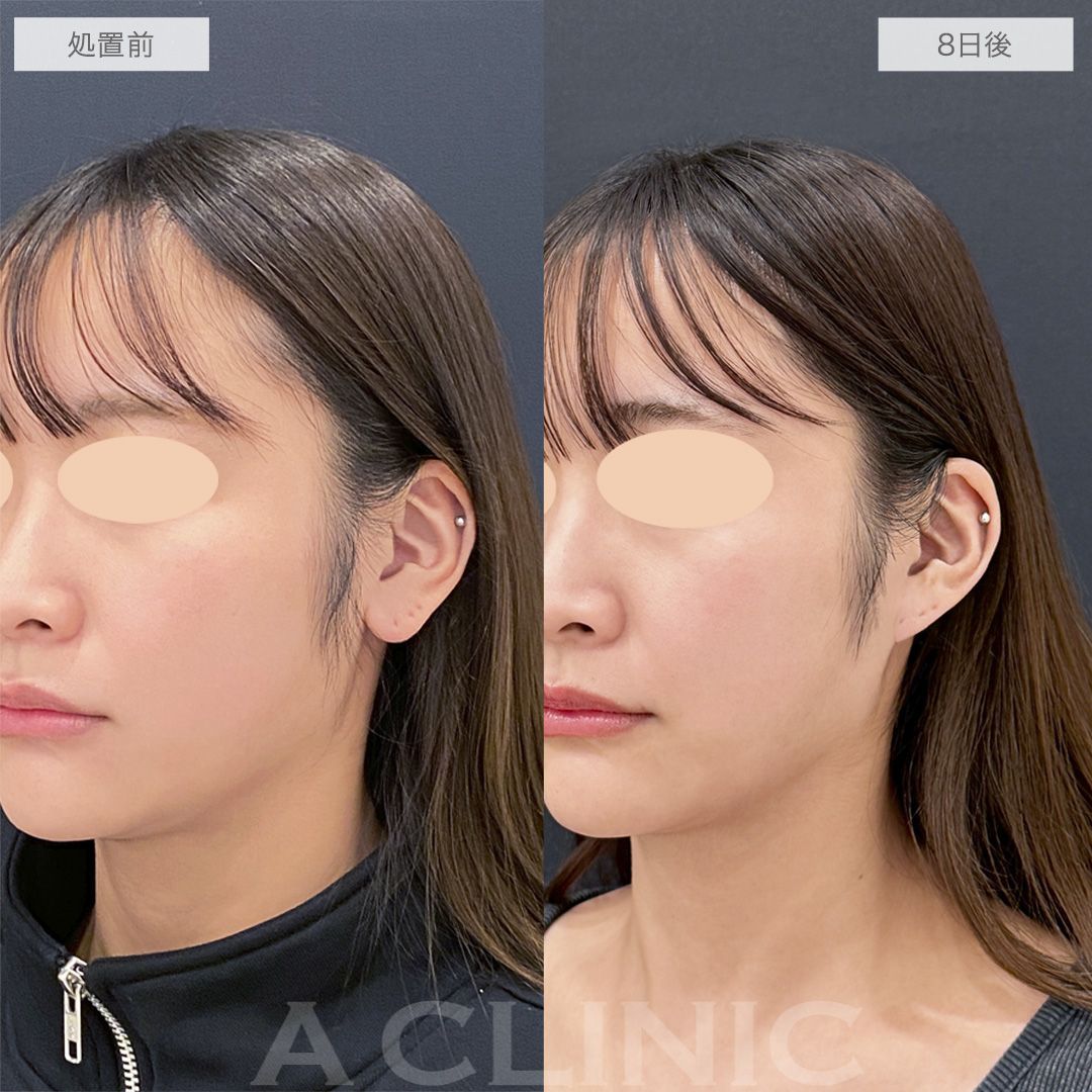 耳たぶ縮小術の症例写真