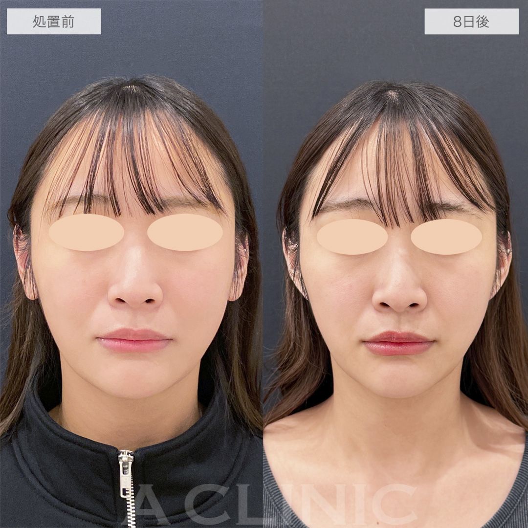 耳たぶ縮小術の症例写真