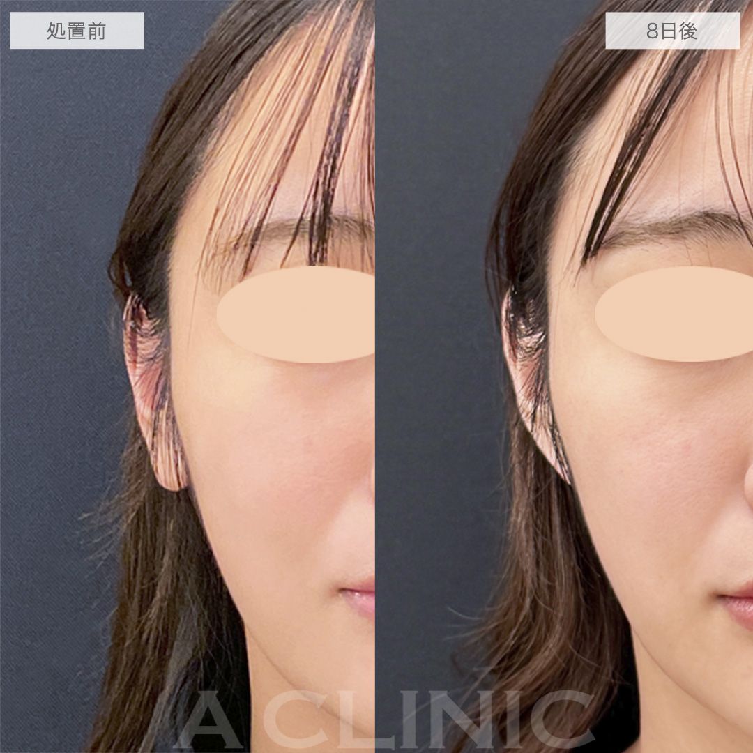 耳たぶ縮小術の症例写真