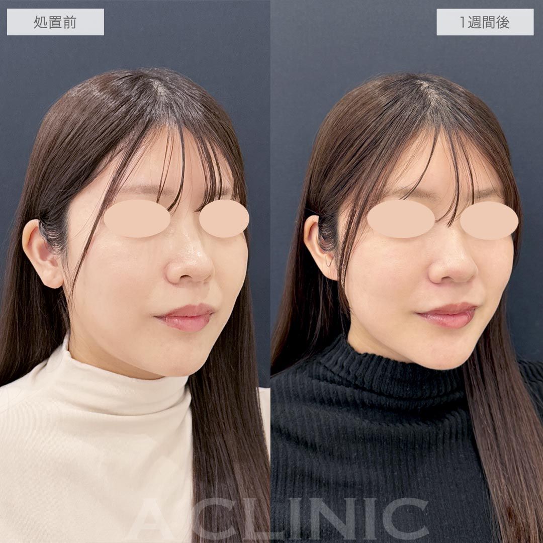 耳たぶ縮小術の症例写真