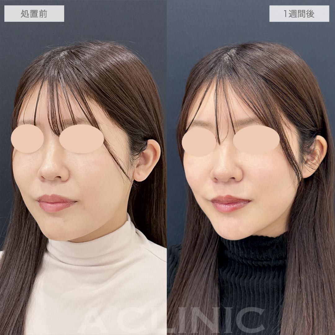 耳たぶ縮小術の症例写真