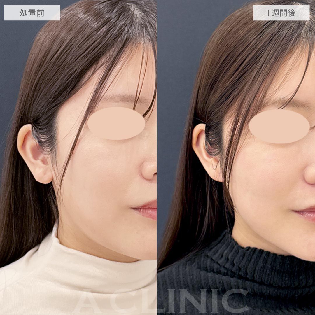 耳たぶ縮小術の症例写真