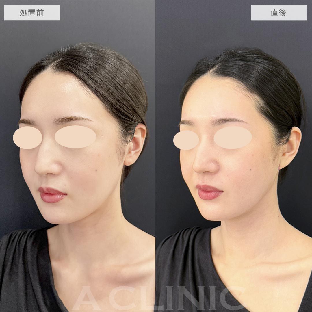 耳たぶ縮小術の症例写真