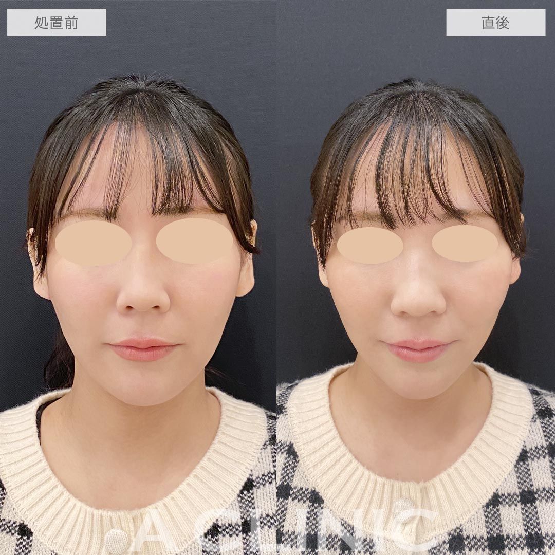 耳たぶ縮小術の症例写真