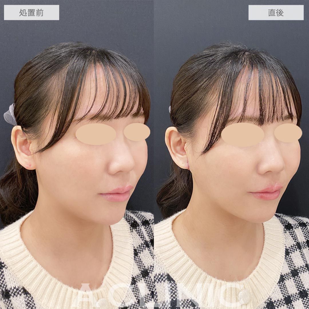 耳たぶ縮小術の症例写真