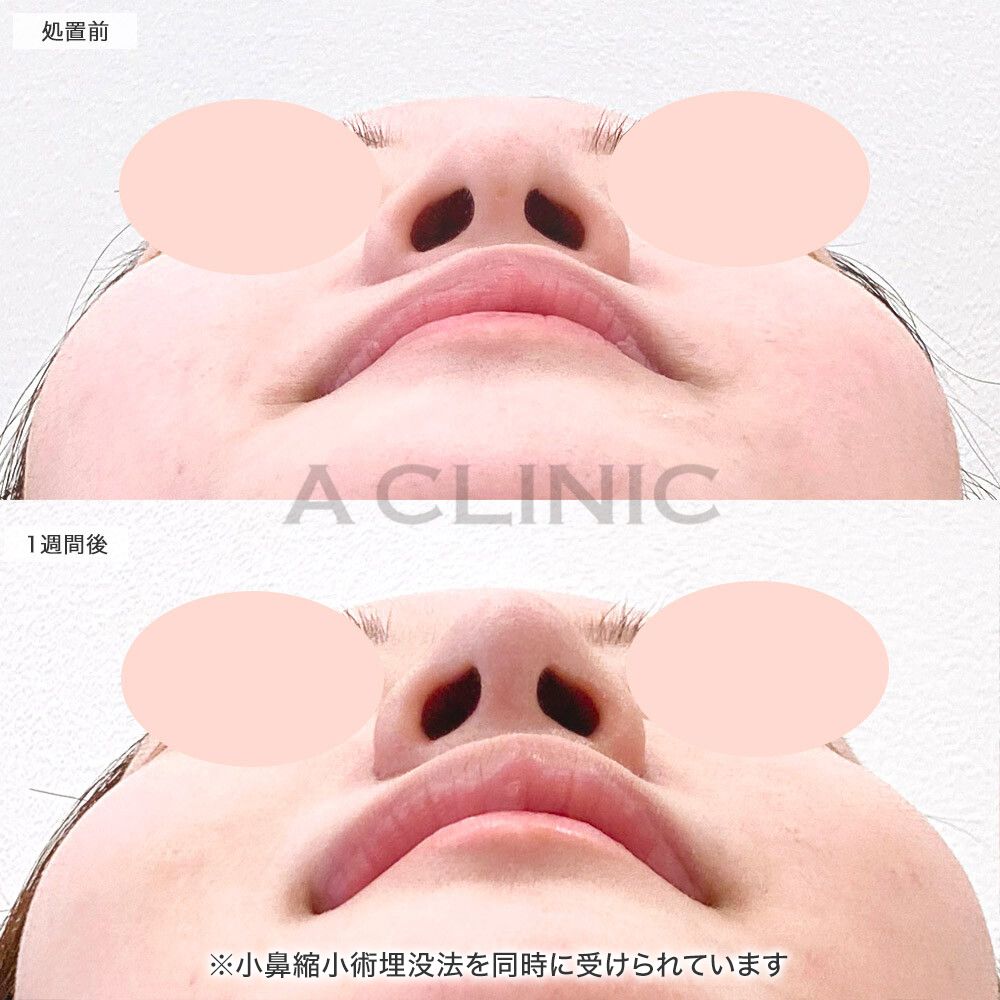 鼻先縮小術埋没法