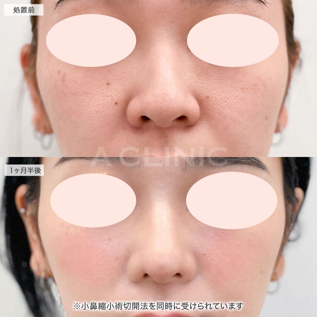 鼻先縮小術埋没法