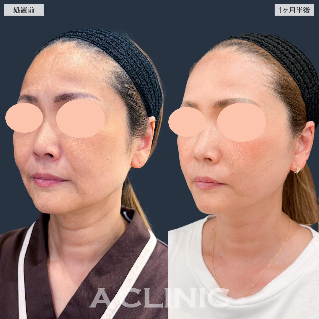 A式ナゾラリフトの症例写真