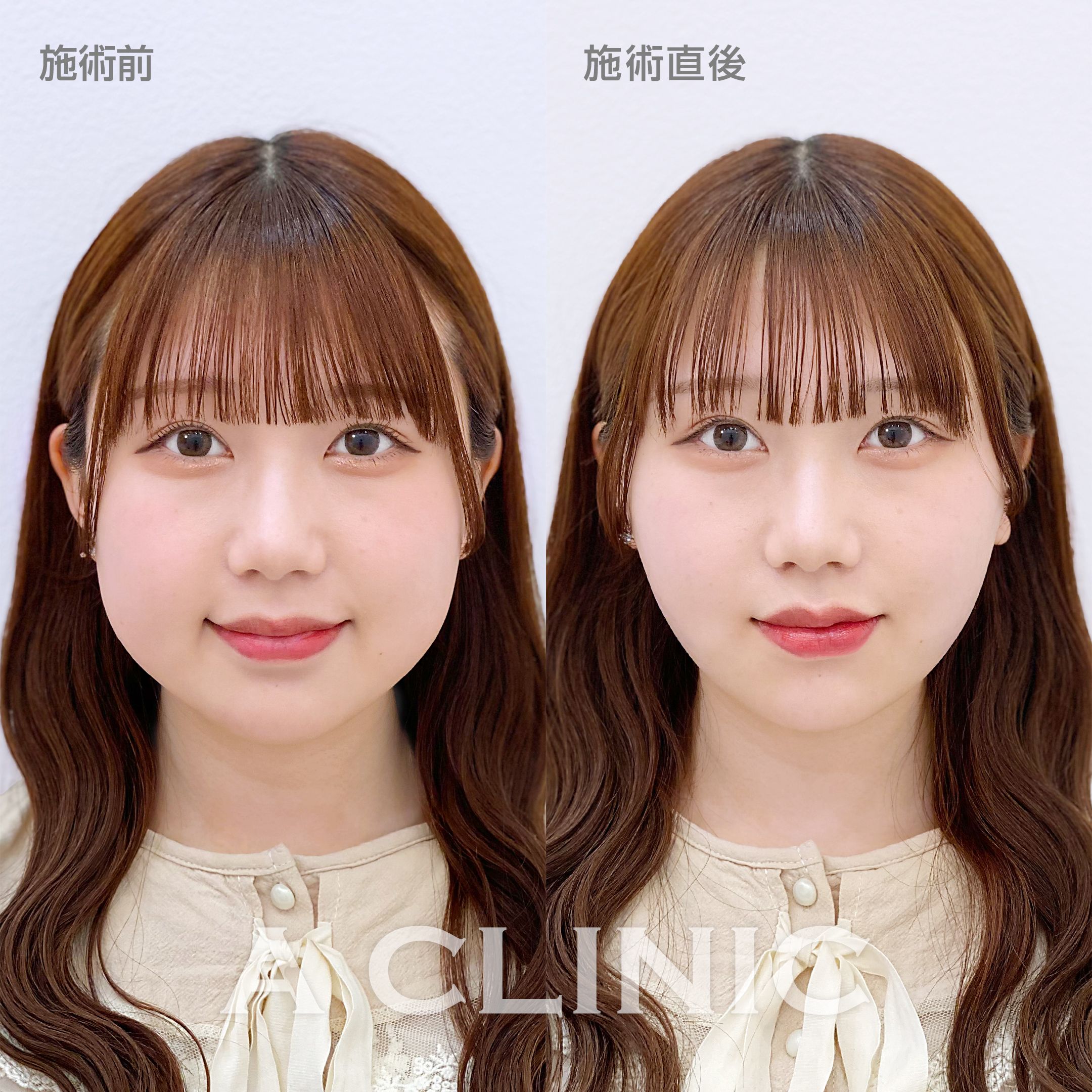 1day小顔脂肪吸引症例写真