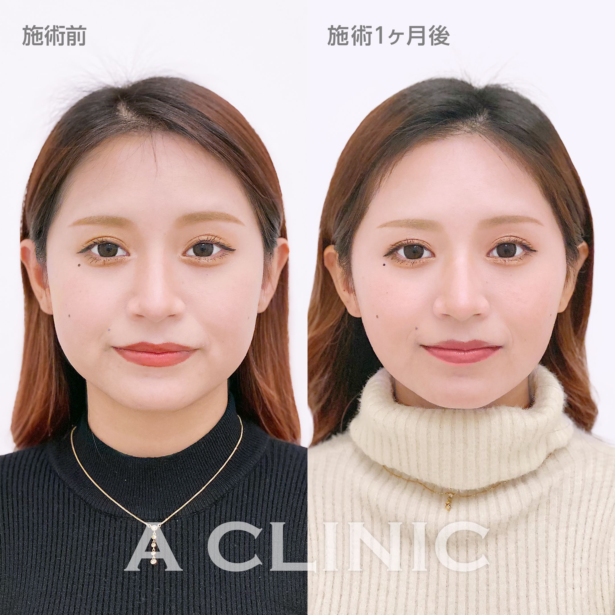 1day小顔脂肪吸引症例写真