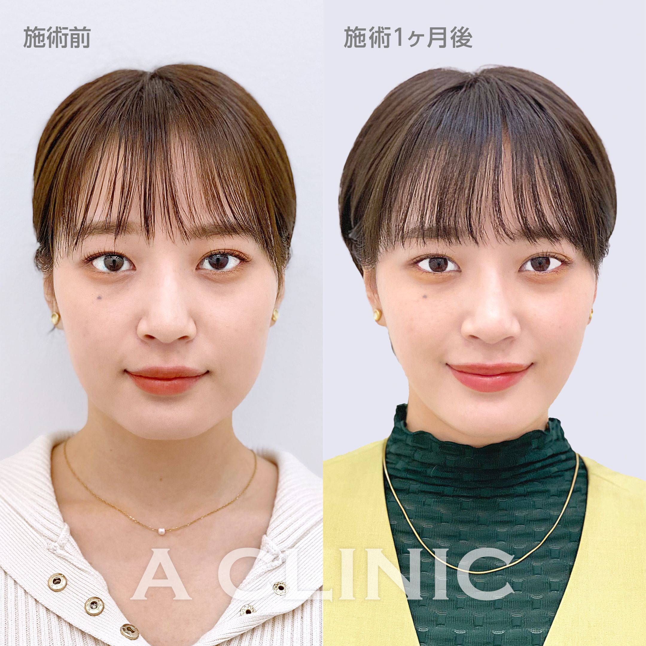 1day小顔脂肪吸引症例写真