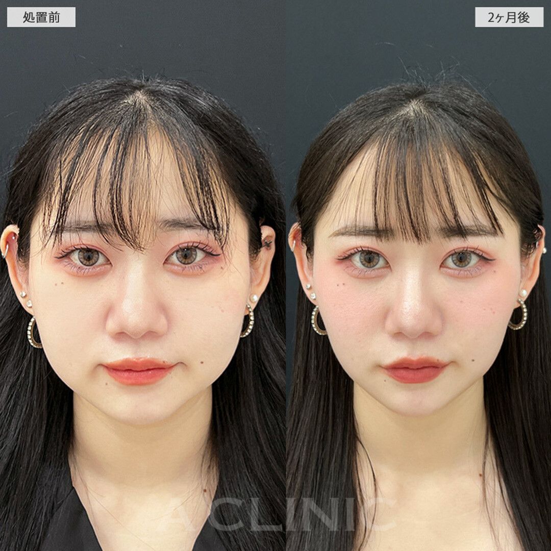 1day小顔脂肪吸引症例写真