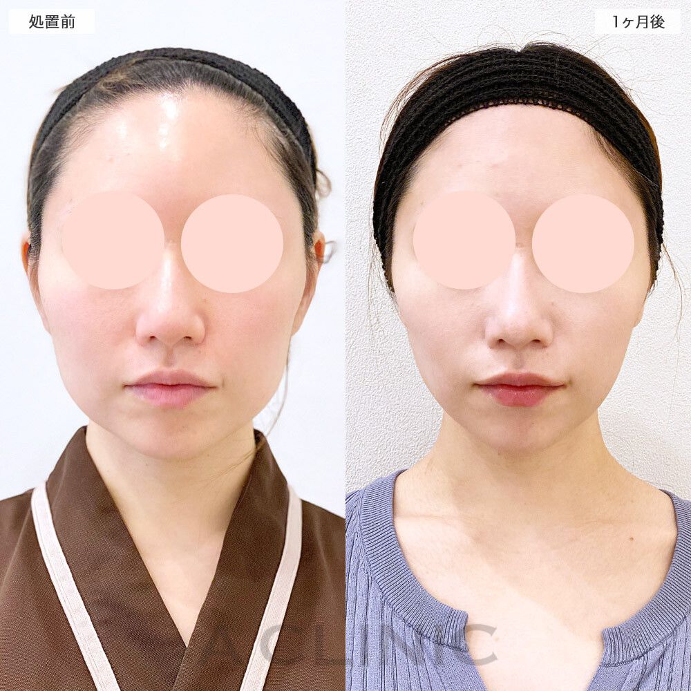 1day小顔脂肪吸引症例写真