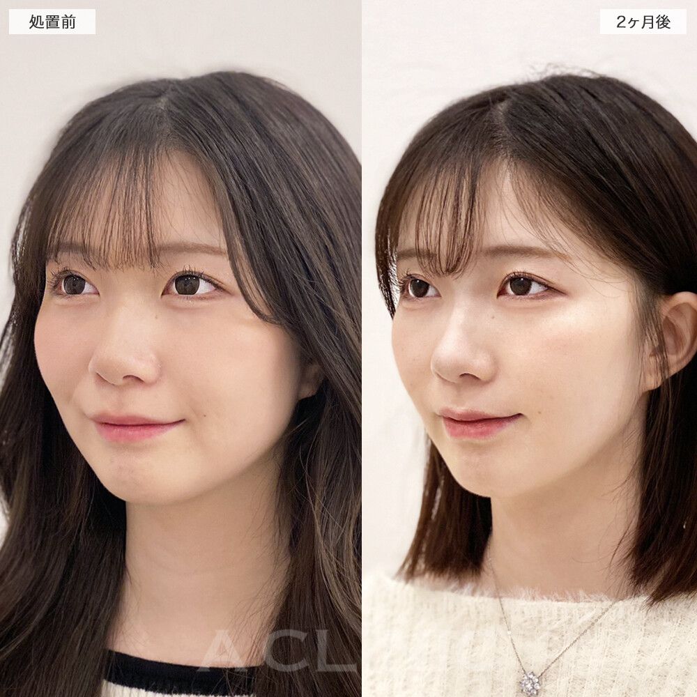 1day小顔脂肪吸引症例写真