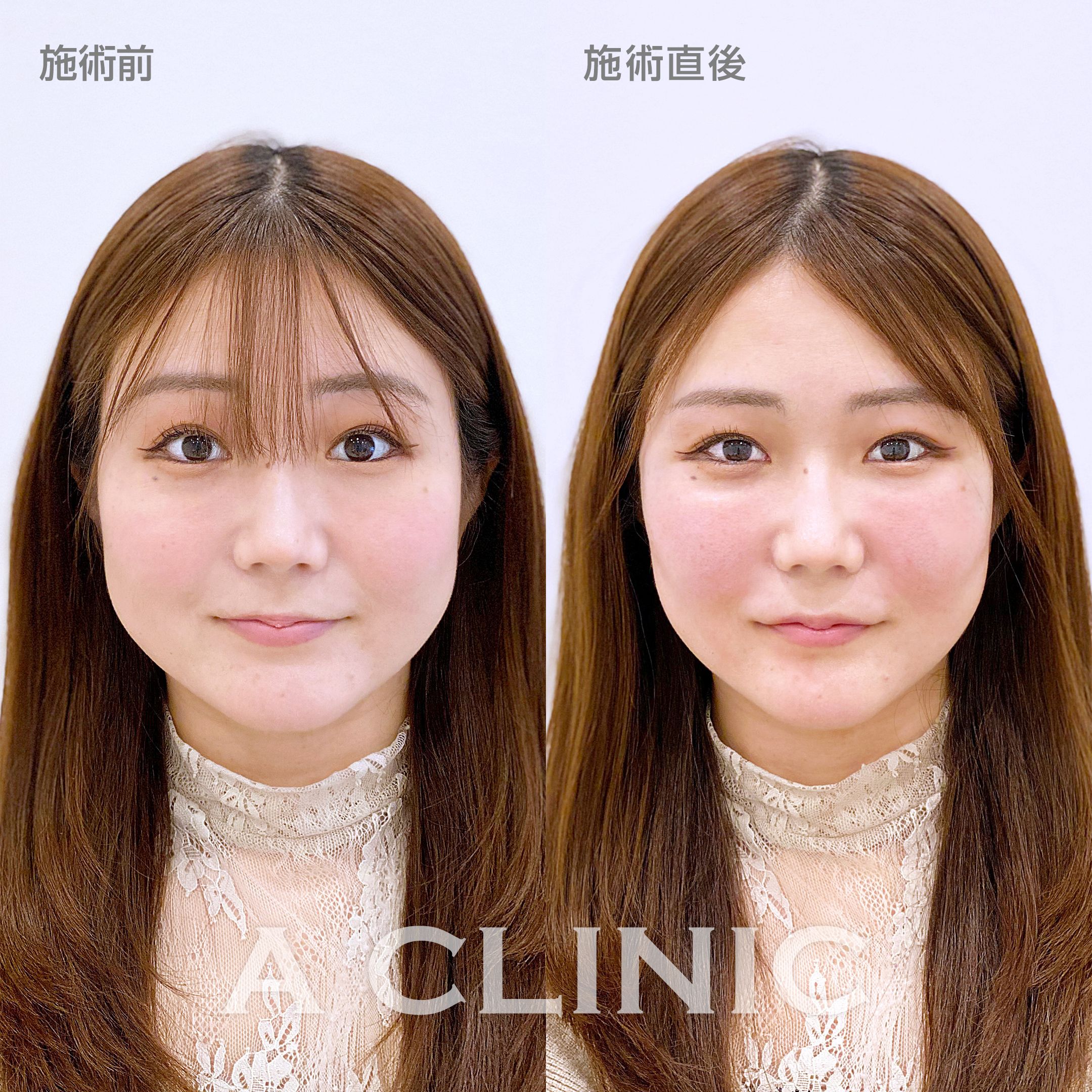 顔の横幅縮小術（脂肪吸引）症例写真