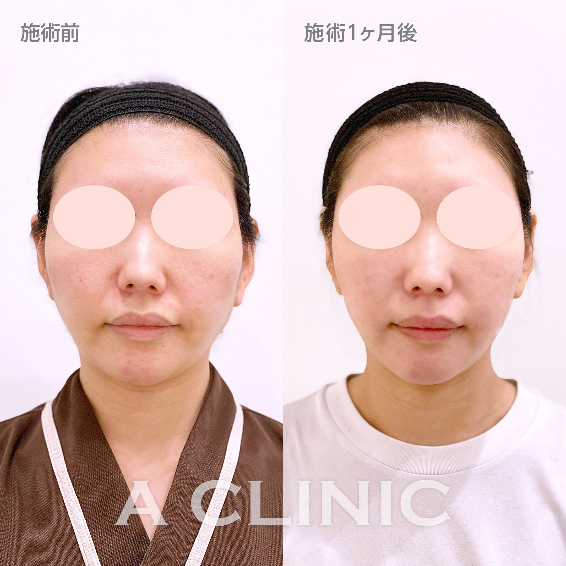顔の横幅縮小術（脂肪吸引）症例写真