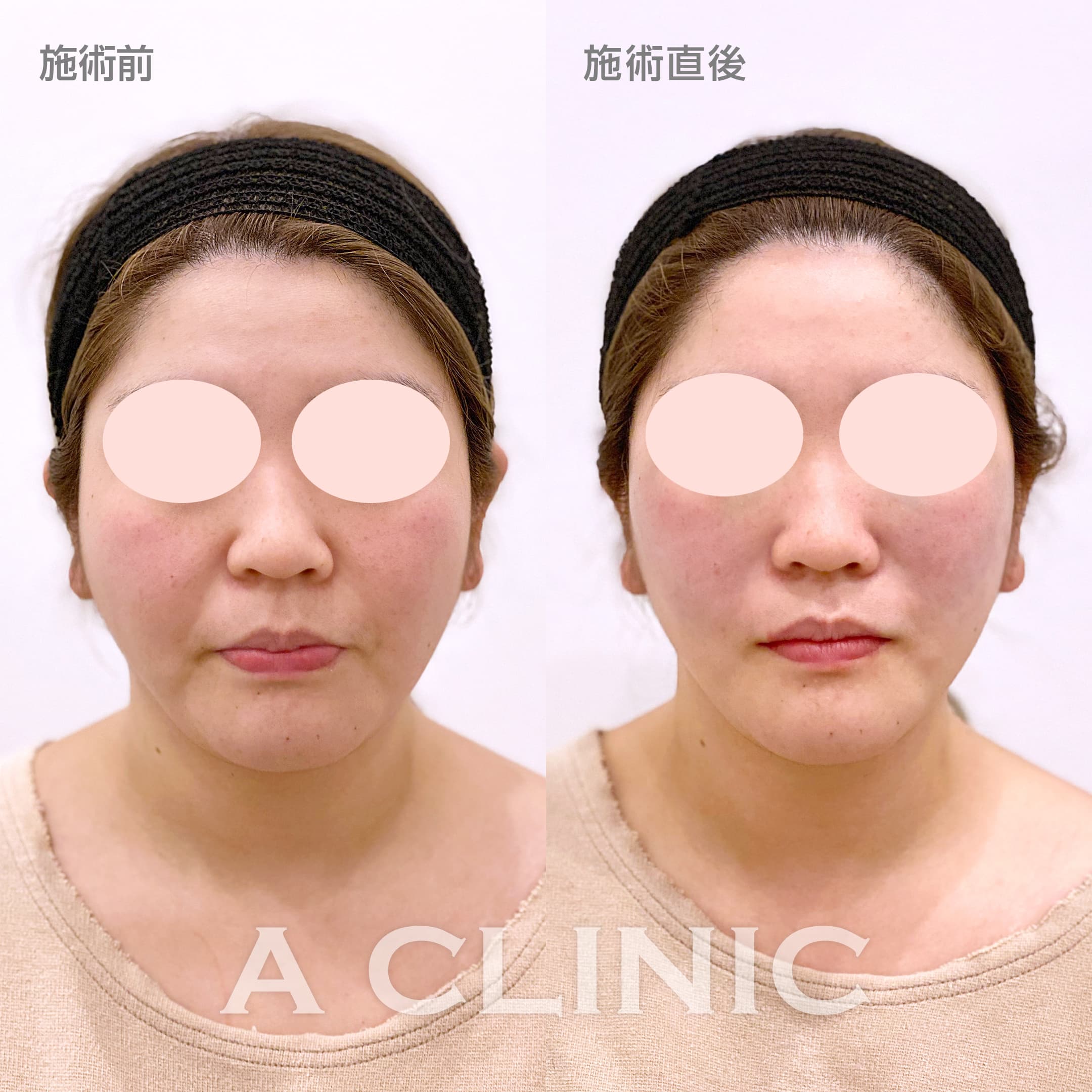 顔の横幅縮小術（脂肪吸引）症例写真