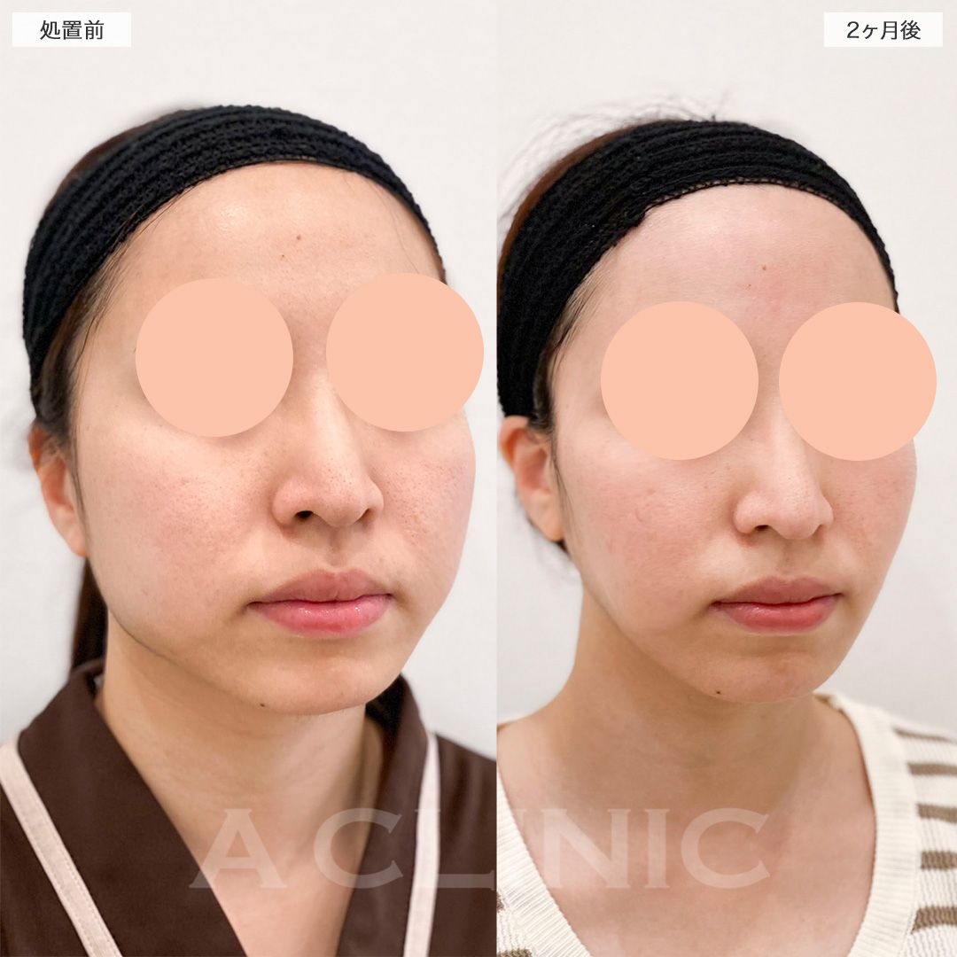 顔の横幅縮小術（脂肪吸引）症例写真