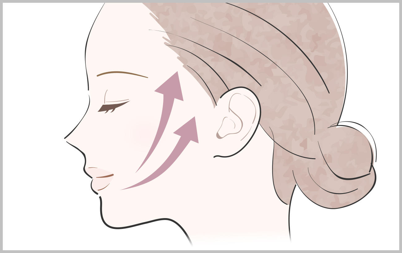 Aスレッド®(糸リフト)
