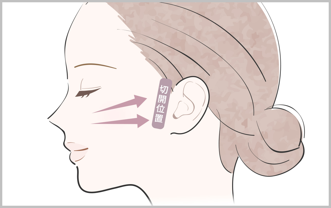 フェイスリフト(切開リフト)