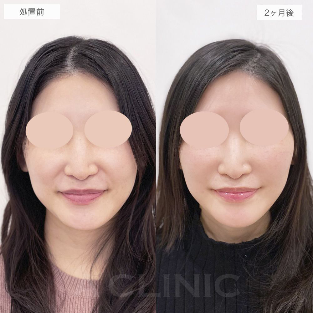 ナゾラビアルファット症例写真