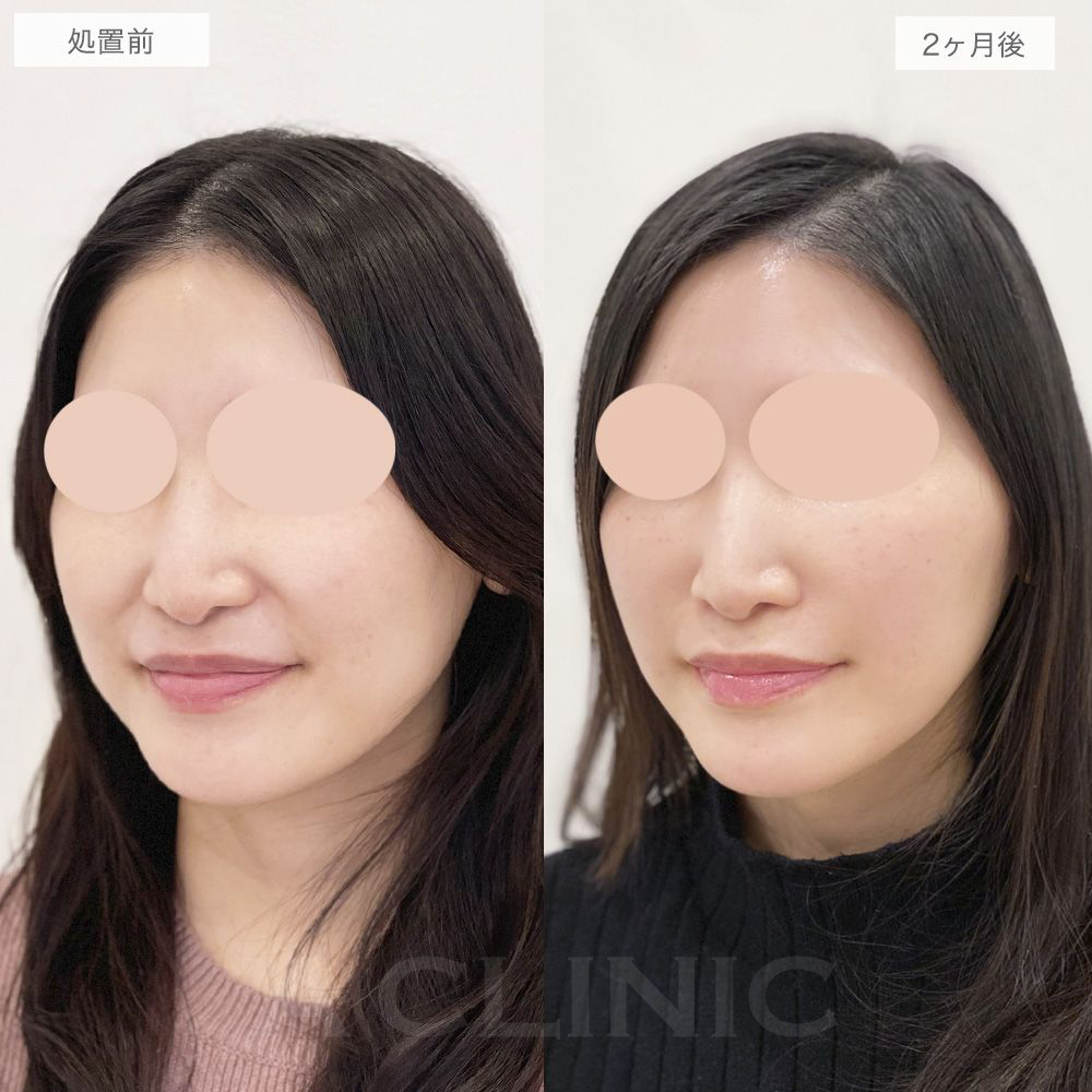 ナゾラビアルファット症例写真