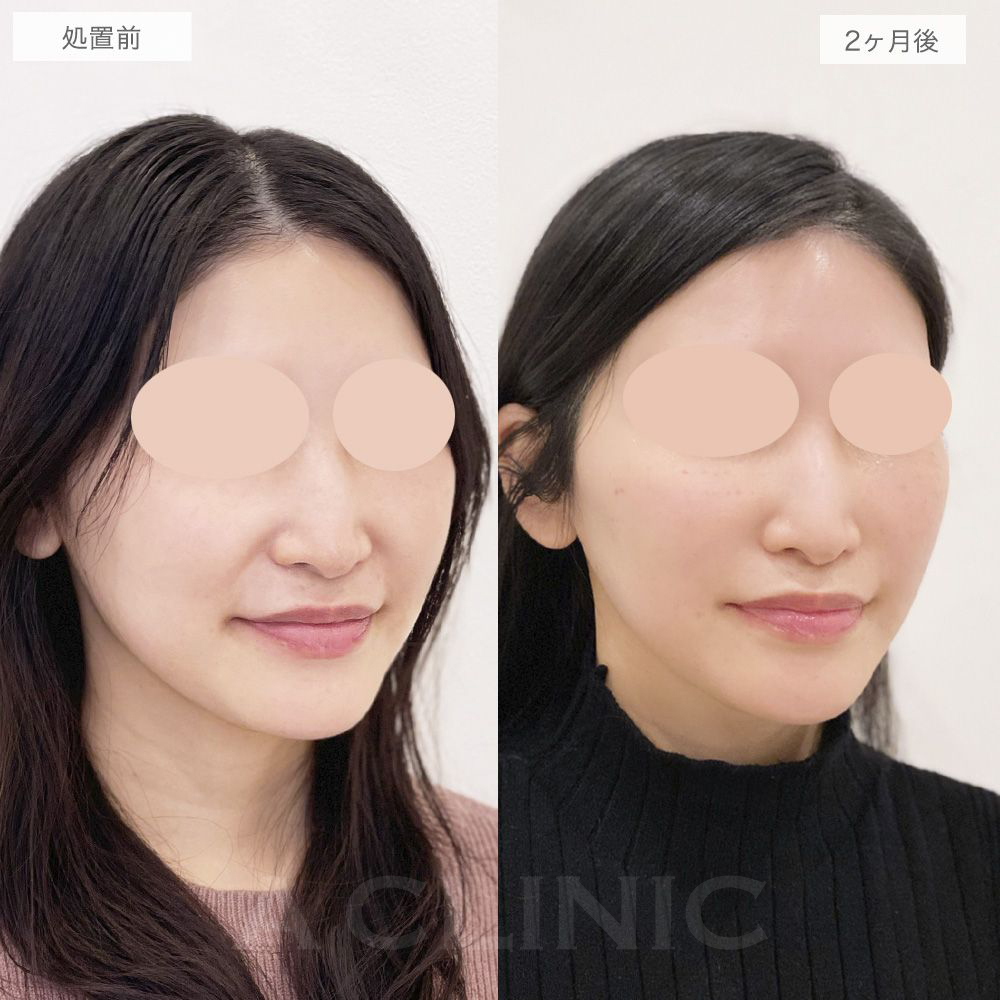 ナゾラビアルファット症例写真