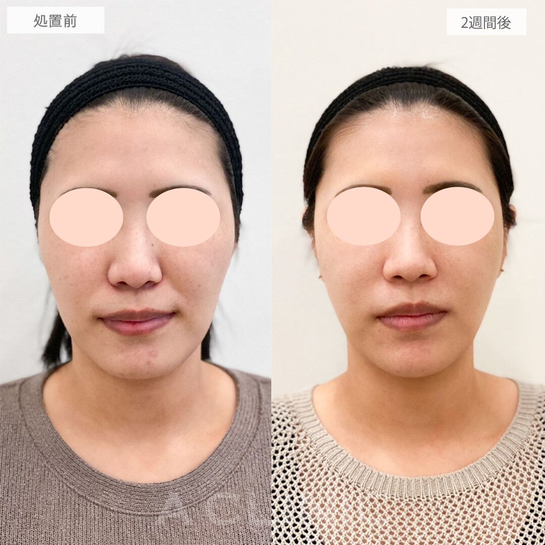 ナゾラビアルファット症例写真