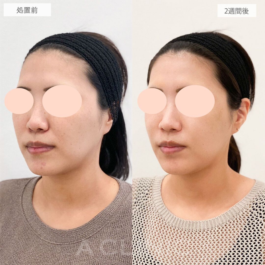 ナゾラビアルファット症例写真