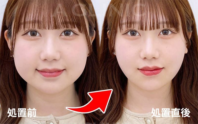 圧倒的な腫れの少なさ1day小顔脂肪吸引