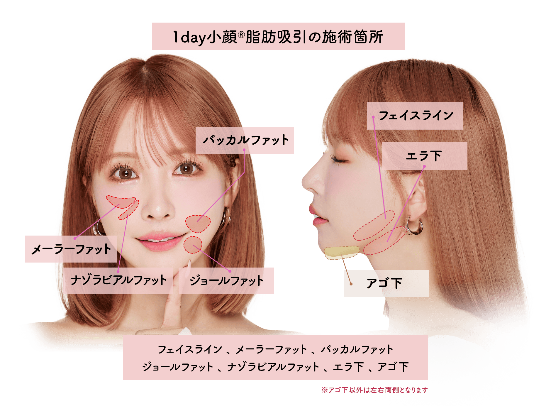 圧倒的な腫れの少なさ1day小顔脂肪吸引