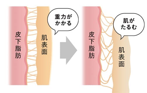 脂肪吸引はたるみの原因となることも