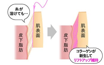 リフトアップが固定される