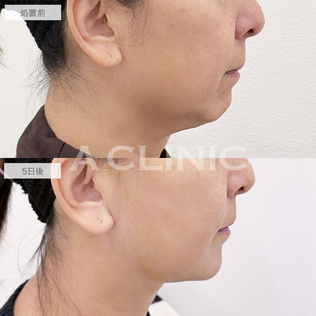 1day小顔®脂肪吸引とアゴ下へのAスレッド®の症例写真BEFORE AFTER 01
