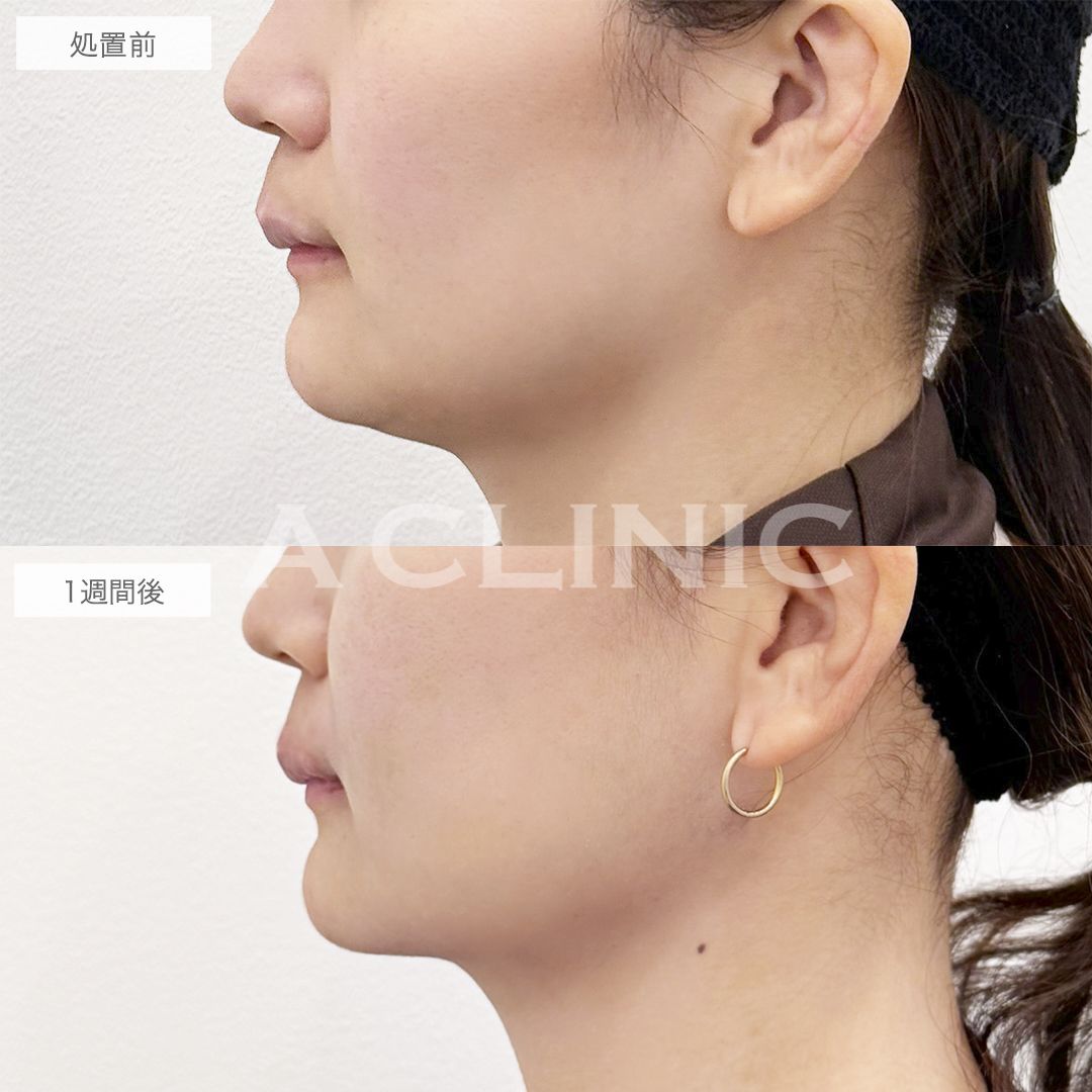 1day小顔®脂肪吸引とアゴ下へのAスレッド®の症例写真BEFORE AFTER 02