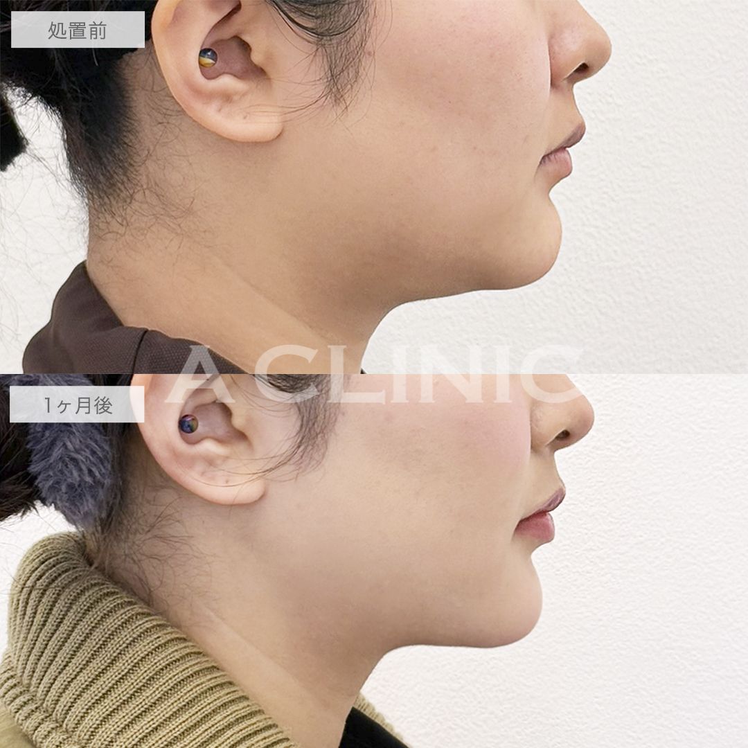 1day小顔®脂肪吸引とアゴ下へのAスレッド®の症例写真BEFORE AFTER 03