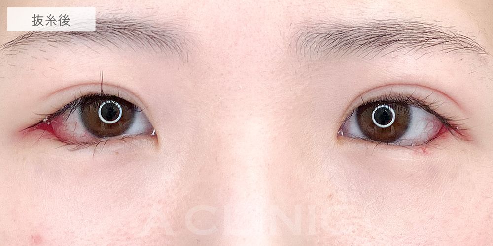 パーフェクトアイズ症例写真11