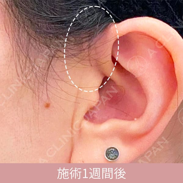フェイスリフトの1週間後の傷跡の写真