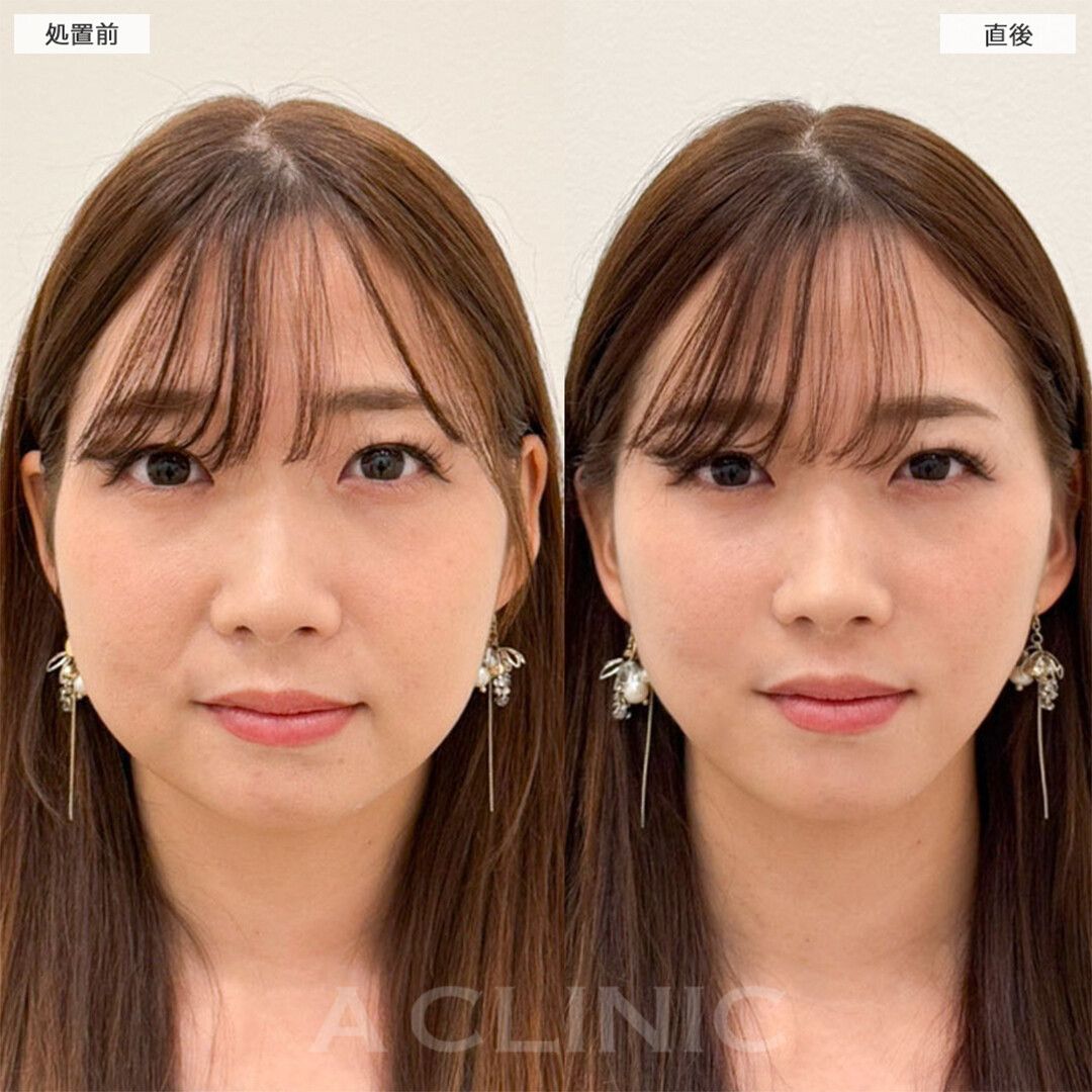 Aスレッド®︎の症例写真