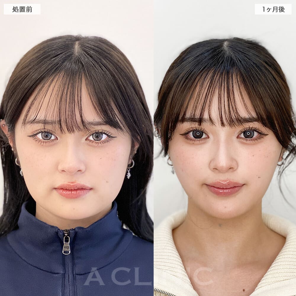 1day小顔脂肪吸引症例写真1
