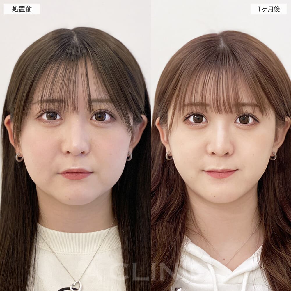 1day小顔脂肪吸引症例写真3