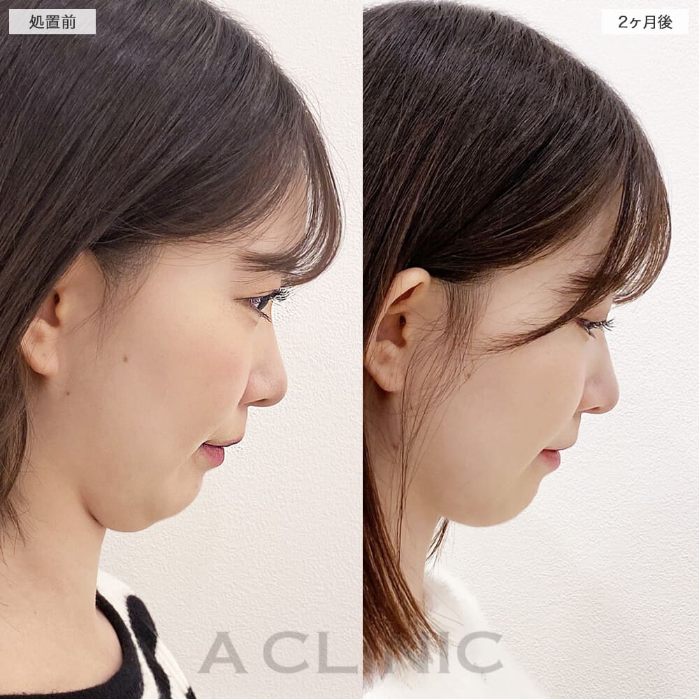 1day小顔脂肪吸引症例写真4