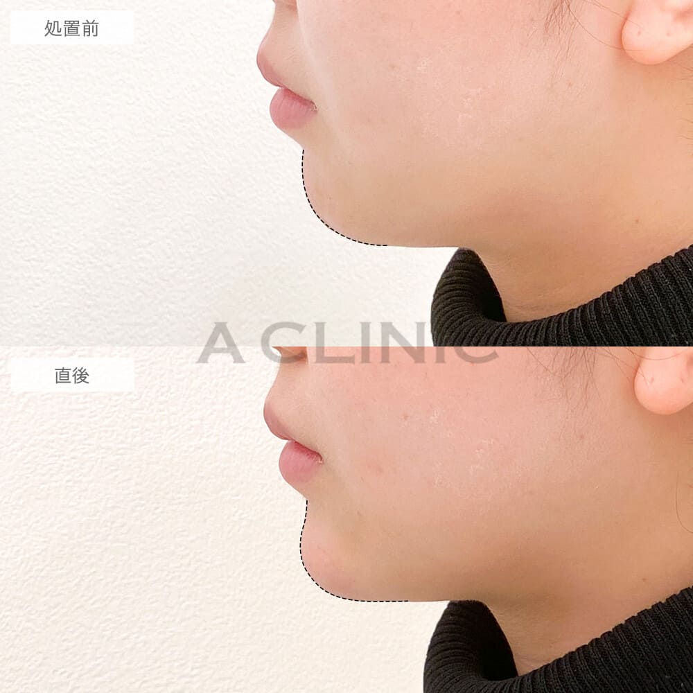 アゴのヒアルロン酸注入症例写真1