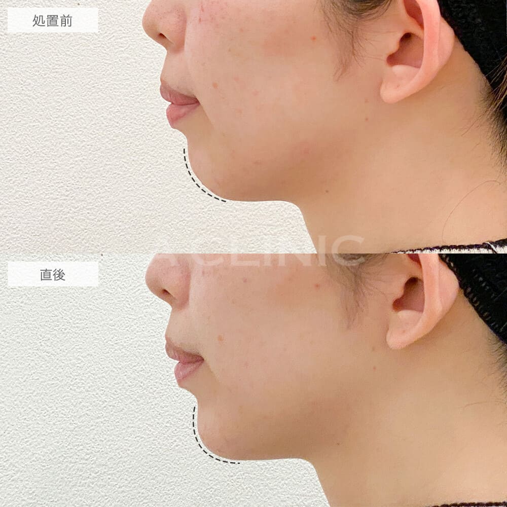 アゴのヒアルロン酸注入症例写真2