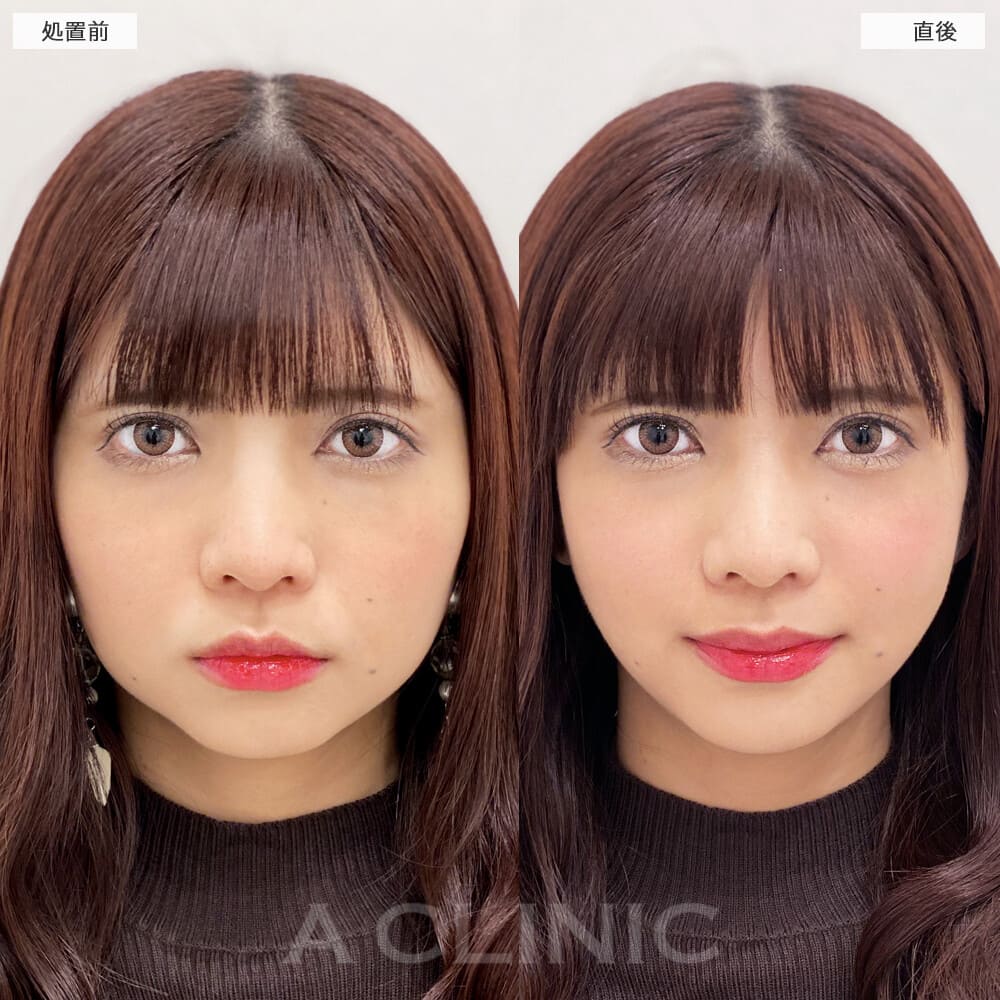 Aスレッド症例写真3