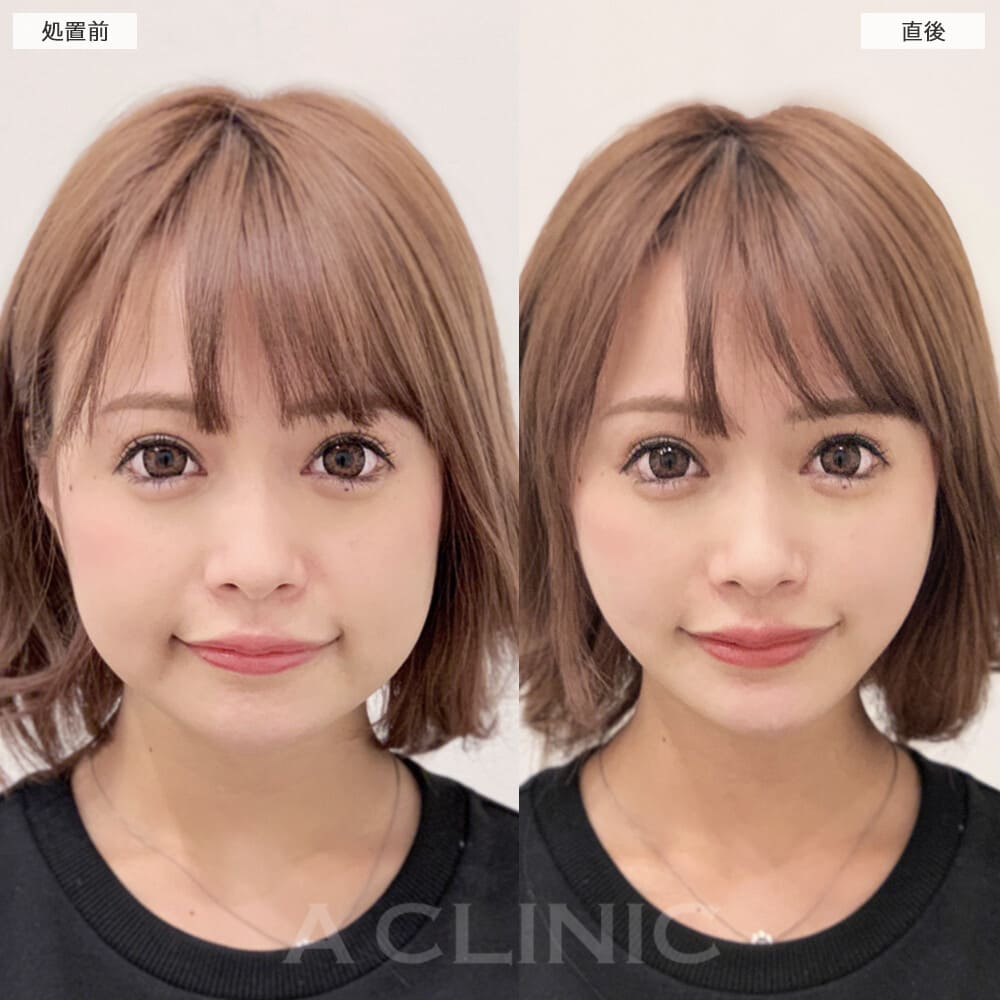Aスレッド症例写真4