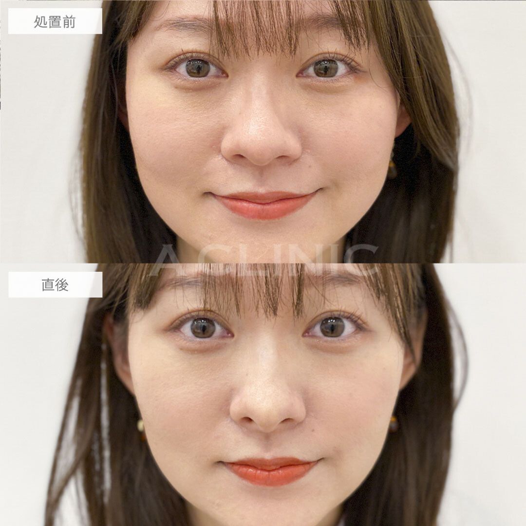 コリアンノーズ/ジャスミンノーズ®︎鼻のヒアルロン酸）症例写真1